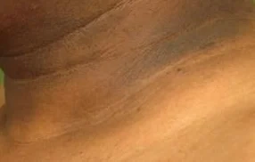 Acanthosis Nigricans: Dark, Thickened, Velvety Patches On The Skin!