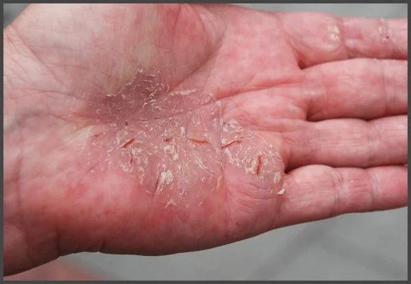 Food Has the Power to Make or Break Our Health! She Came to Me to Lose Weight, but Got Rid of the Psoriatic Patches and Arthritis of Hands Instead!